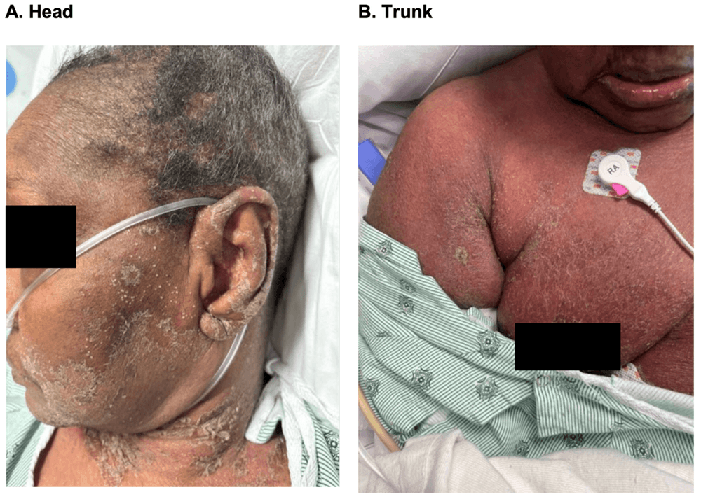 Intravenous and subcutaneous spesolimab use in a medically comorbid patient with erythrodermic generalized pustular psoriasis