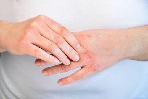 FC24: Chronic Hand Eczema: Hope on the Horizon: An Online Activity