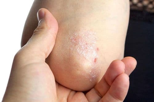 The ABC’s of GLP’s and Psoriatic Disease: An Online Activity