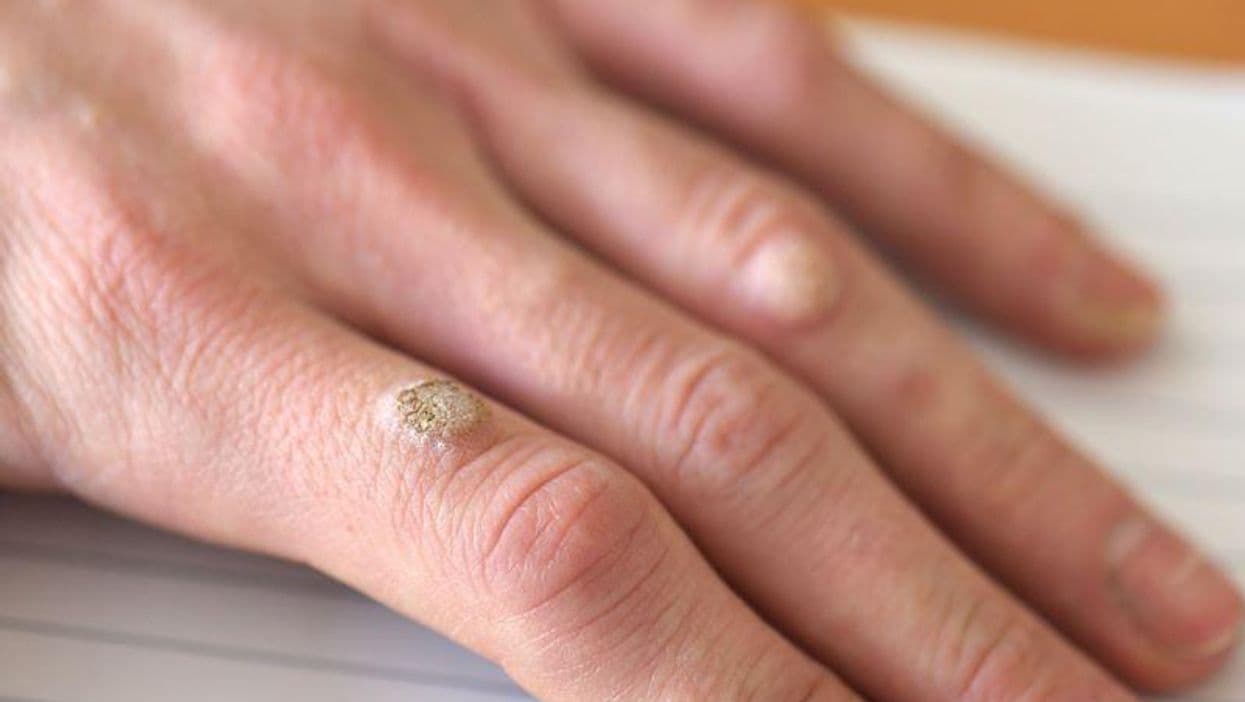 Annual Costs Estimated for Wart Treatment in the U.S. for 2015-2017