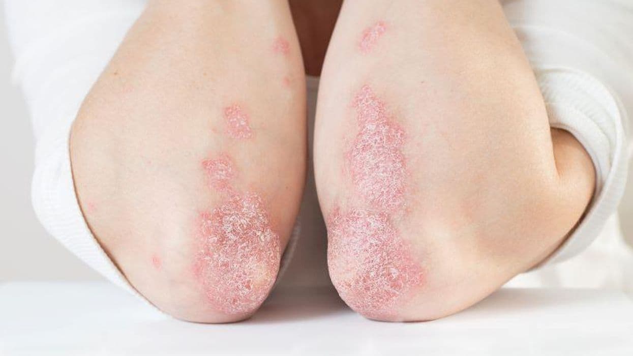 Causal Effect ID'd for IBD With Psoriasis, Psoriatic Arthritis