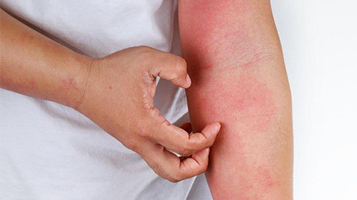 Is Delgocitinib Ointment an Effective Treatment for Pediatric Eczema?