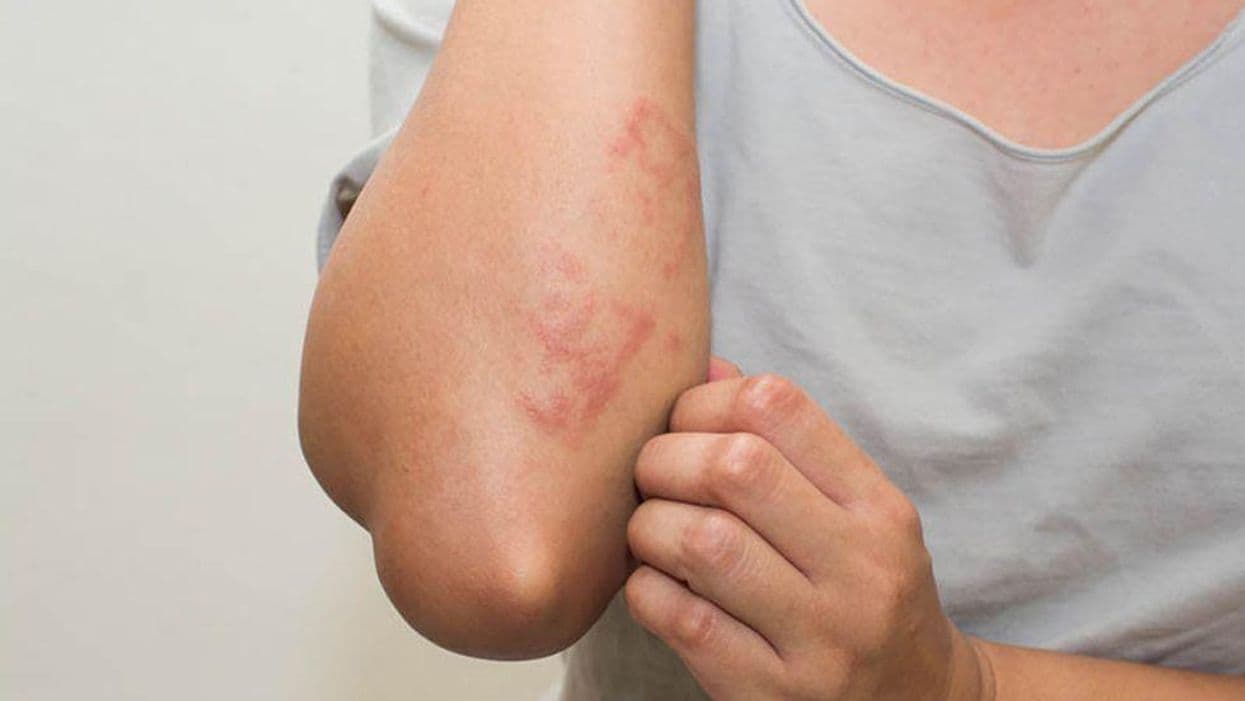 Rash, Itch After COVID Vaccine Rare & Quickly Resolves