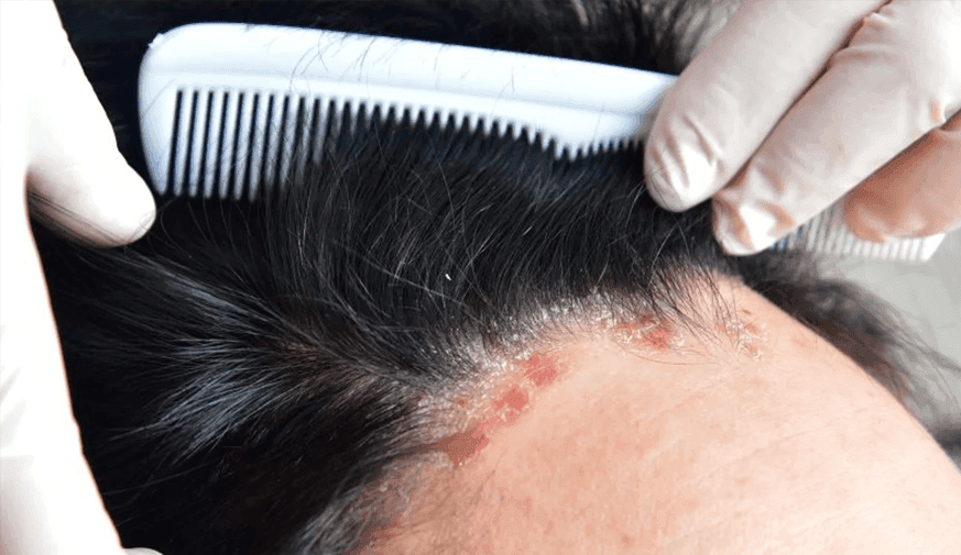 Tacrolimus Microemulsion Has Good Efficacy, Safety for Scalp Psoriasis