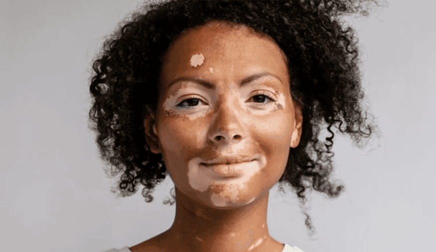 Incidence Rates of Cancer Not Increased in Patients With Vitiligo