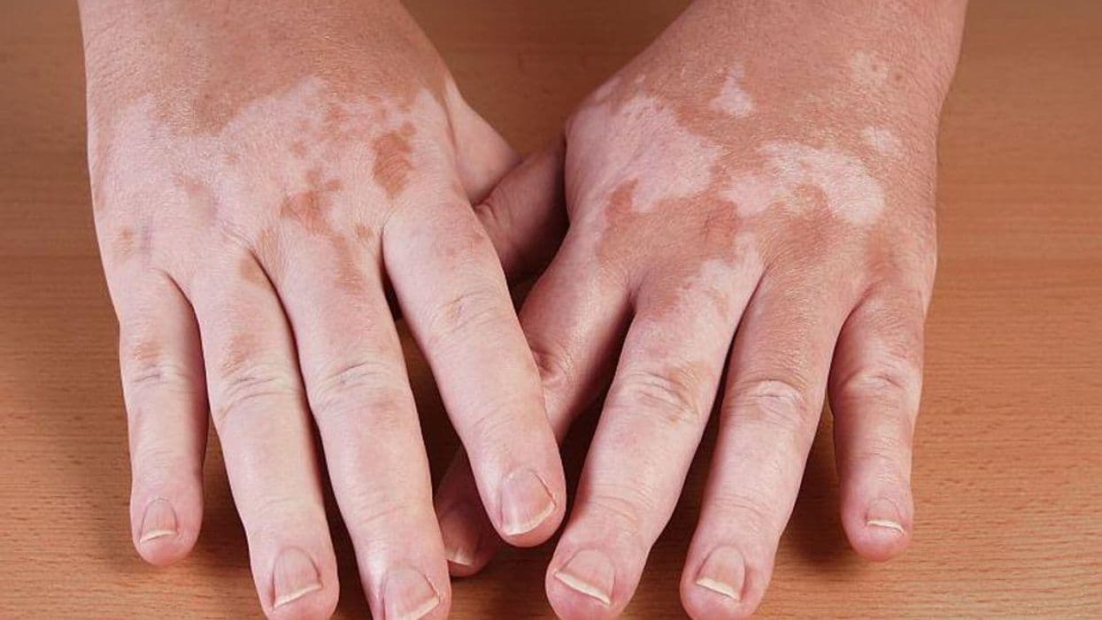 What Is the Prevalence of Vitiligo in the United States?
