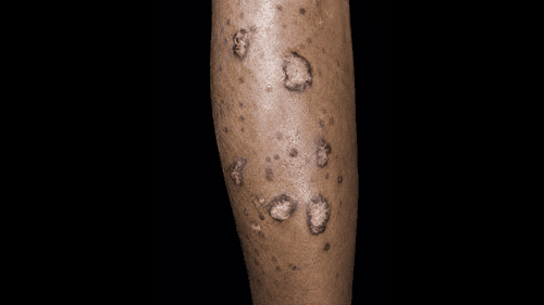 2026 Congress of Clinical Rheumatology Rheum-Derm Summit: Skin Signals: Cutaneous Lupus Erythematosus Manifestations and Management